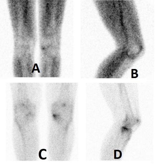 Obr.1.: Obraz zvenho krevnho poolu v lemu kolem distlnho konce levho femuru mediln v pedn a lev bon mediln projekci (A, B) a statick scany se zvenou depozic RF v subchondrln lokalizaci na proximln tibii vlevo mediln a na patele v tch projekcch (C, D). Nlez odpovd  artrotickm zmnm v korelaci s RTG a s obrazem synovialitidy.