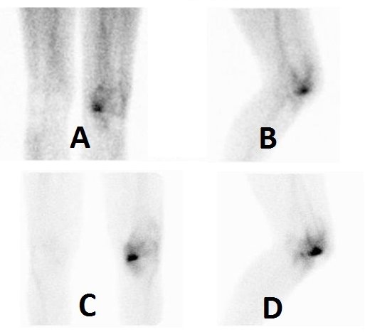 Obr.2.: Obraz zvenho krevnho poolu v lemu kolem distlnho konce levho femuru  mediln  v pedn a lev bon mediln projekci  (A, B)  a statick scany se zvenou depozic RF v medilnm kondylu levho femuru v tch projekcch (C, D). Nlez odpovd pokozen kloubn plochy femuru s obrazem leh synovialitidy.