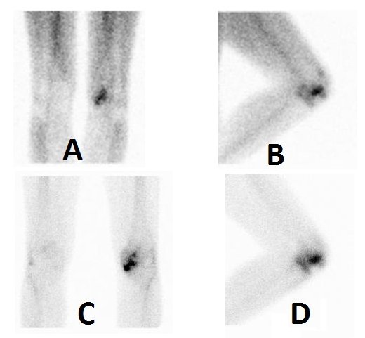 Obr.4.: Obraz zvenho krevnho poolu fokln a v lemu kolem distlnho konce levho femuru mediln v pedn a lev bon mediln projekci (A, B) a statick scany se zvenou depozic RF v subchondrln lokalizaci na proximln tibii vlevo mediln a na patele v tch projekcch (C, D). Nlez odpovd artrotickm zmnm a pokozen kloubn plochy femuru mediln v korelaci s RTG a s obrazem synovialitidy.
