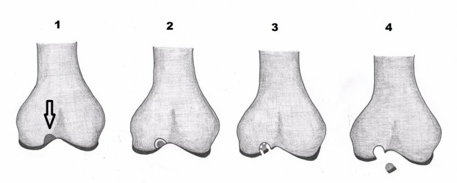Obr.6.: Stdia disekujc osteochondritidy 1-4. 1- vyznaen stabiln lze v kosti, 2 - naznaen odlouen fragmentu v kosti, 3 - fragmentace chrupavky, 4 - dislokace fragmentu s obrazem osteochondrlnho defektu na LDCT.