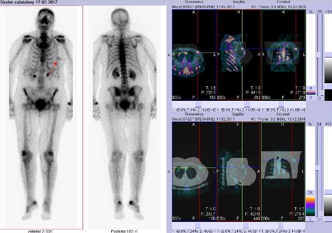 Obr. . 2: Celotlov scintigramy a fze obraz SPECT a CT. Zameno na loisko v levm prsu. ezy transverzln, sagitln a koronln.