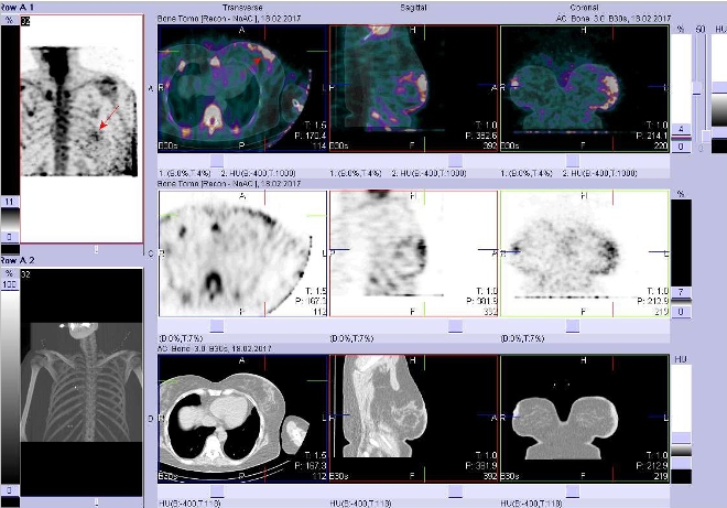 Obr. . 2: Fze obraz SPECT a CT. Zameno na loisko v levm prsu. ezy transverzln, sagitln a koronln. Nahoe fze SPECT/CT, uprosted SPECT, dole CT.