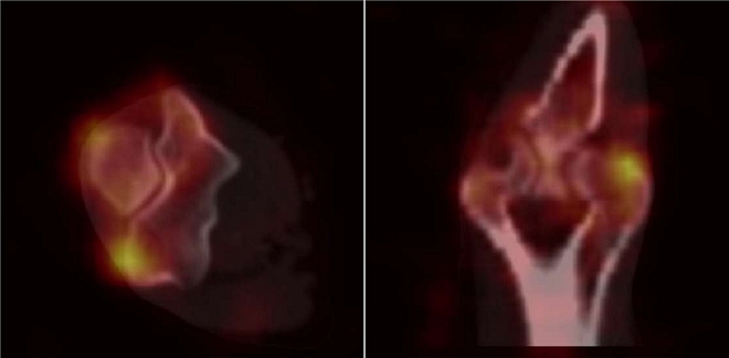 Obr..4: MIP SPECT/low dose CT pravho loketnho kloubu s nlezem zven akumulace radiofarmaka  v oblasti radilnho epikondylu  lev obrzek je v rovin transverzln, prav v rovin koronrn v supinan poloze ruky.