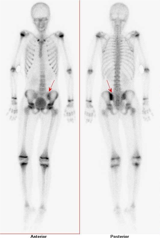 Obr..3: Celotlov scintigrafie skeletu v pedn a zadn projekci -  patologicky zven akumulace 99mTc-HDP vlevm SI sklouben, fyziologicky zven akumulace vrstovch znch dlouhch kost.