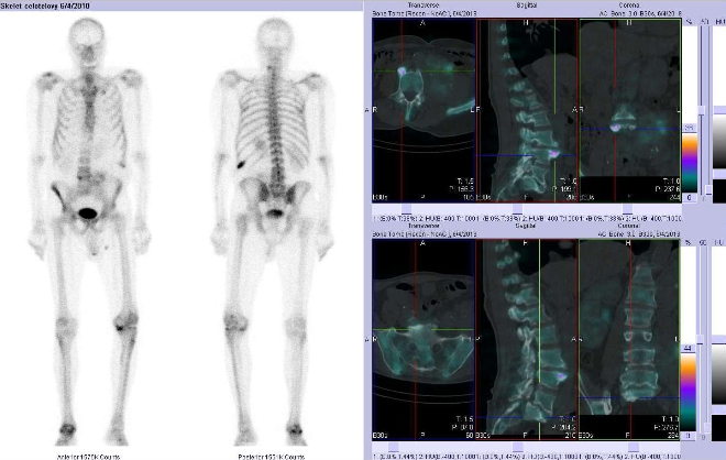 Obr..1: Celotlov scintigrafie v pedn a zadn projekci a fze obraz SPECT a CT.  Vpravo zameno na degenerativn loiska v bedern ptei. ezy transverzln, ezy sagitln a ezy koronln.