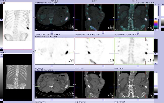 Obr. . 2: Fze obraz SPECT a CT.  Zameno na loisko vdorzln sti 11. ebra vlevo. Vpravo nahoe fze SPECT/CT, vpravo uprosted SPECT, vpravo dole CT. ezy transverzln, ezy sagitln a ezy koronln.