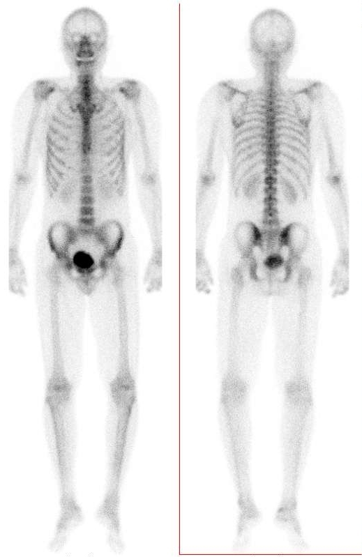 Obr. . 2: Celotlov scintigrafie skeletu v pedn a zadn projekci s nlezem mrn zven akumulace radiofarmaka v oblasti prav patn kosti - patrn ze zadn projekce.