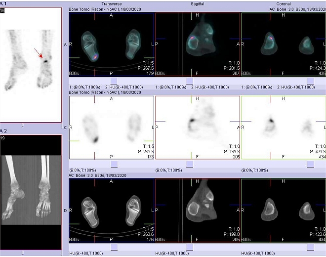 Obr. . 3: SPECT/low dose CT s nlezem zven akumulace radiofarmaka v oblasti tuber calcanei prav patn kosti.