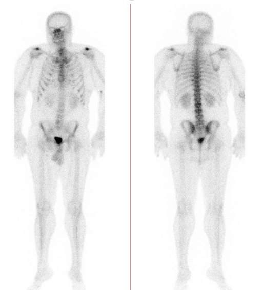 Obr..1: Celotlov scintigrafie skeletu v pedn a zadn projekci s nlezem mrn zven depozice radiofarmaka v oblasti acromioklaviulrnho sklouben bilat., v ostatnch stech skeletu je jeho fyziologick depozice.