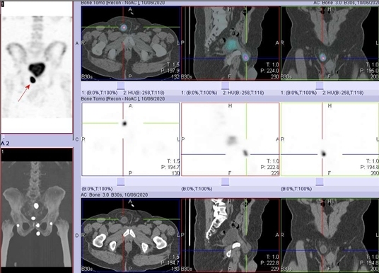 Obr. . 2: SPECT/low dose CT s nlezem akumulace radiofarmaka v sti moovho mche, kter je soust inguinln hernie vpravo  viz ipka.