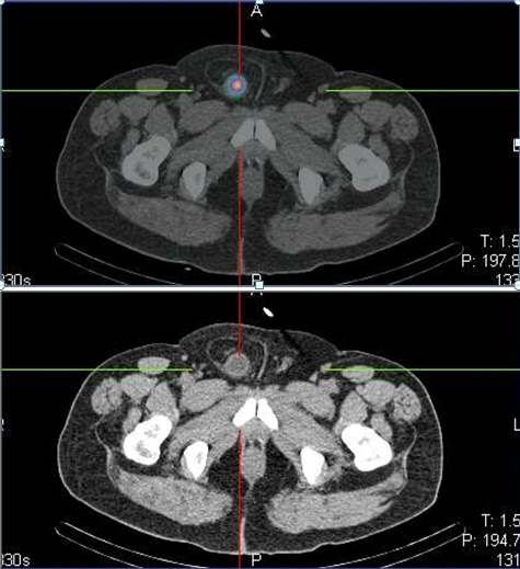 Obr. . 3: Detail SPECT/low dose CT  fzovanho snmku a  CT snmku v transverzlnm ezu  s nlezem  akumulace radiofarmaka vmoovm mchi, kter je soust inguinln hernie vpravo.