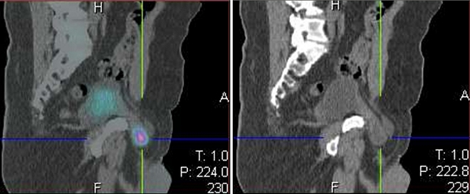 Obr..4: Detail SPECT/low dose CT  fzovanho snmku a  CT snmku v sagitlnm ezu s nlezem akumulace radiofarmaka v moovm mchi, kter je soust  inguinln hernie vpravo.