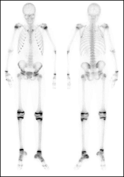 Obr. . 2: Celotlov scintigrafie skeletu v pedn a zadn projekci s nlezem mrn zven akumulace radiofarmaka vdorsln sti patn kosti vlevo.