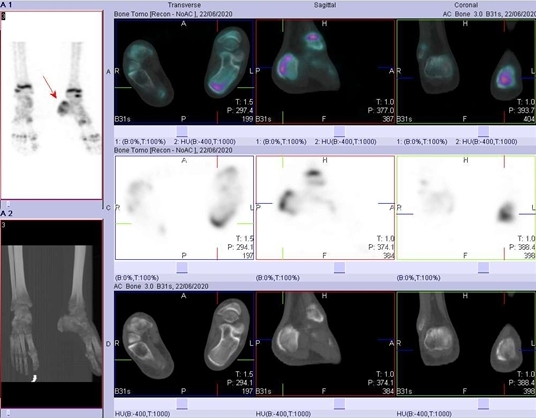Obr. . 3: SPECT/low dose CT s nlezem zven akumulace radiofarmaka vdorsln sti patn kosti vlevo.