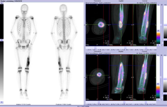Obr. . 1: Celotlov scintigrafie v pedn a zadn projekci a fze obraz SPECT a CT. Vpravo zameno na loisko v lev stehenn kosti. ezy transverzln, sagitln a koronln.