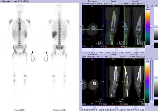 Obr. . 3: Celotlov scintigrafie v pedn a zadn projekci a fze obraz SPECT a CT za 4 hod. po aplikaci radiofarmaka. Vpravo zameno na levou stehenn kost.