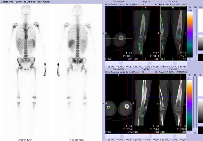 Obr. . 4: Celotlov scintigrafie v pedn a zadn projekci a fze obraz SPECT a CT za 24 hod. po aplikaci radiofarmaka. Vpravo zameno na levou stehenn kost.