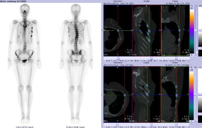 Obr. . 1: Celotlov scintigrafie vpedn a zadn projekci a fze obraz SPECT a CT.  Vpravo zameno na  loiska v laterln sti 6. a 7. ebra vlevo. ezy transverzln,  sagitln a koronln.