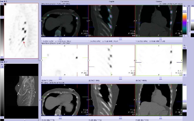 Obr. . 2: Fze obraz SPECT a CT.  Zameno na loisko v v laterln sti  8. ebra vlevo. Vpravo nahoe fze SPECT/CT, vpravo uprosted SPECT, vpravo dole CT. ezy transverzln, sagitln a koronln.