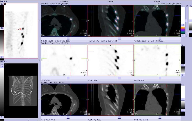 Obr. . 3: Fze obraz SPECT a CT.  Zameno na loisko v v laterln sti  5. ebra vlevo. Vpravo nahoe fze SPECT/CT, vpravo uprosted SPECT, vpravo dole CT. ezy transverzln, sagitln a koronln.