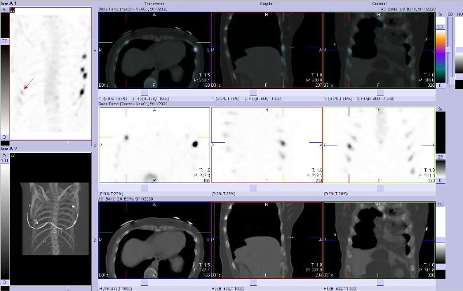Obr. . 4: Fze obraz SPECT a CT.  Zameno na loisko ve ventrolaterln stijednoho ebra vpravo. Vpravo nahoe fze SPECT/CT, vpravo uprosted SPECT, vpravo dole CT. ezy transverzln, sagitln a koronln.