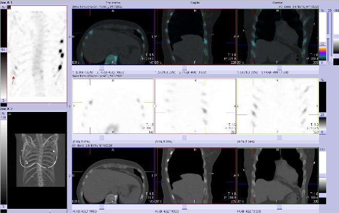 Obr. . 5: Fze obraz SPECT a CT.  Zameno na loisko ve ventrolaterln sti jednoho ebra vpravo. Vpravo nahoe fze SPECT/CT, vpravo uprosted SPECT, vpravo dole CT. ezy transverzln, sagitln a koronln.