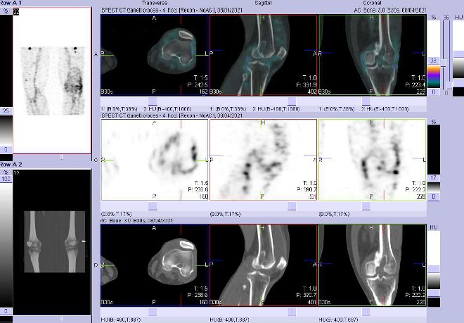 Obr. . 2: Fze obraz SPECT a CT za 4 hod. po aplikaci radiofarmaka. Zameno na lev koleno.