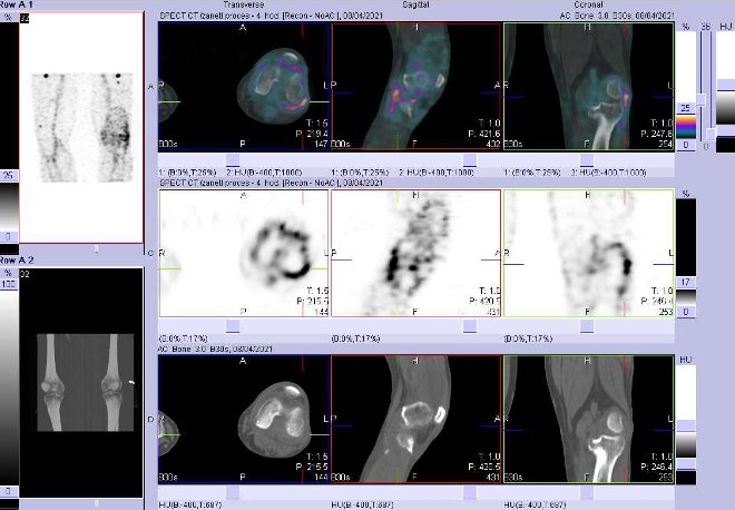 Obr. . 3: Fze obraz SPECT a CT za 4 hod. po aplikaci radiofarmaka. Zameno na lev koleno.