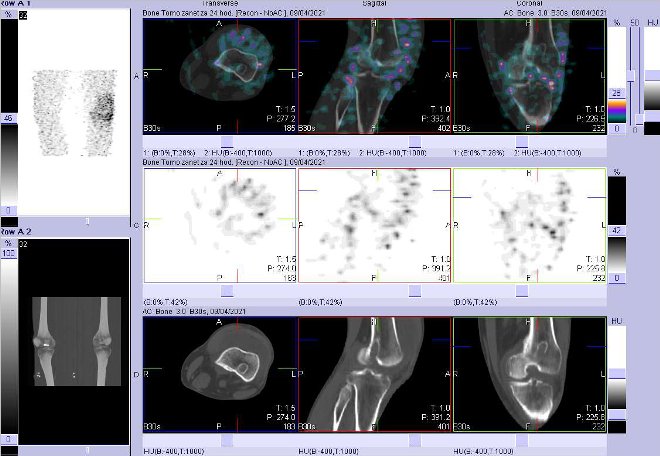 Obr. . 4: Fze obraz SPECT a CT za 24 hod. po aplikaci radiofarmaka. Zameno na lev koleno. Dobe patrn kanl ve stehenn kosti.