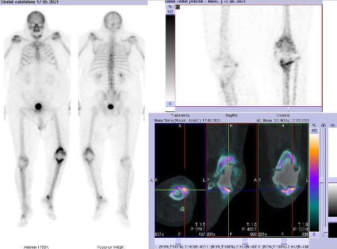 Obr..2: Celotlov scintigrafie a fze obraz SPECT a CT. Zameno na lev koleno.