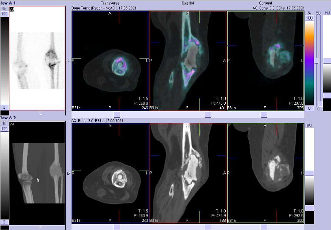 Obr. . 3: Fze obraz SPECT a CT. Zameno na lev koleno.