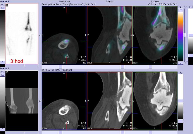 Obr. . 5: Fze obraz SPECT a CT za 3 hod. po aplikaci radiofarmaka. Zameno na lev koleno.