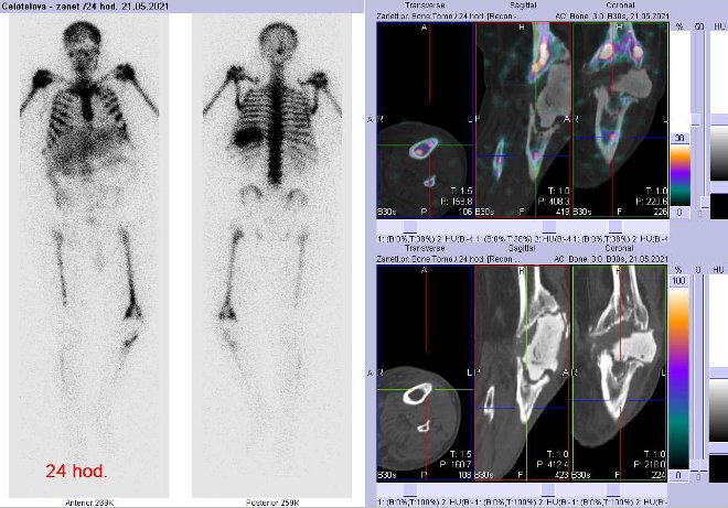 Obr. . 6: Celotlov scintigrafie a fze obraz SPECT a CT za 24 hod. po aplikaci radiofarmaka. Zameno na lev koleno.