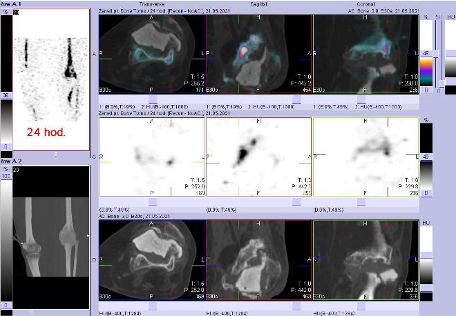 Obr. . 7: Fze obraz SPECT a CT za 24 hod. po aplikaci radiofarmaka. Zameno na lev koleno.