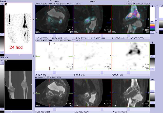 Obr. . 8: Fze obraz SPECT a CT za 24 hod. po aplikaci radiofarmaka. Zameno na lev koleno.