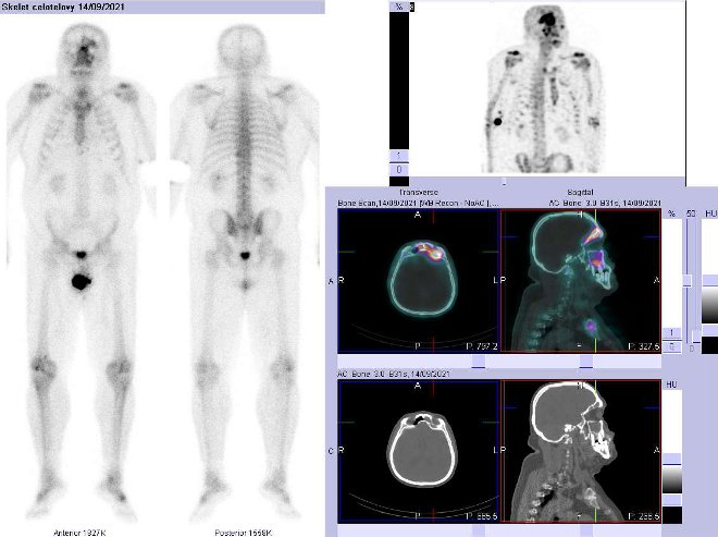 Obr..1: Celotlov scintigrafie vpedn a zadn projekci a fze obraz SPECT a CT.  Vpravo zameno na  loisko vlebce.