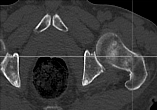 Obr.3.: Na low dose CT pánve obraz jemných sklerotizací v obou acetabulech, stydkých kostech i proximálním konci levého femuru.