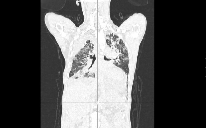 Obr.4.: Na low dose CT hrudníku v plicním okně tumorózní proces v S6, atelektáza části dolního laloku vpravo, a nově oproti vstupnímu CT řada okrsků zastření mléčného skla.