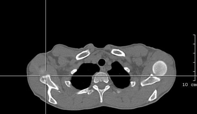 Obr.3.: Detail osteolytické léze v glenoidu pravé lopatky na low dose.