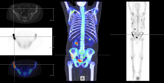 Obr.2.: Celotělový SPECT, fúze obrazů SPECT a CT, na transverzálních řezech pod sebou CT, SPECT, fúze SPECT/CT. Se zaměřením na výrazné osteolytické metastatické ložisko v pravé lopatě kosti kyčelní.