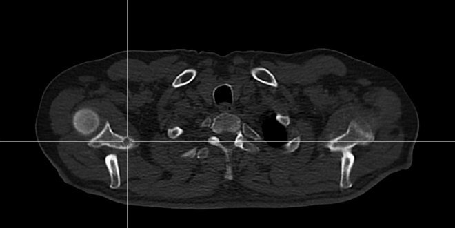 Obr.4.:Na low dose CT osteolytické metastatické ložisko v pravé lopatce.