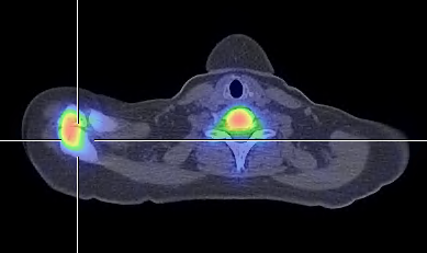 Obr.3.: Fúze SPECT/CT v axiálním řezu v pozdní fázi v zvýšená akumulace RF mezi os acromiale a acromiem vpravo.