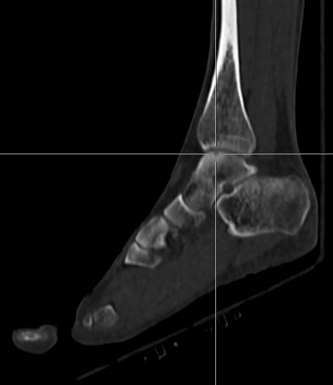 Obr.4.: Detail osteochondrlnho defektu PDK na CT obraze v sagitlnm ezu.