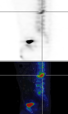 Obr.4.: SPECT a fúze SPECT/CT v sagitálním řezu - v pozdní fázi zvýšená akumulace RF v (komprimovaném) obratlovém těle L2 a mírně zvýšená akumulace v obratlovém těla L4.