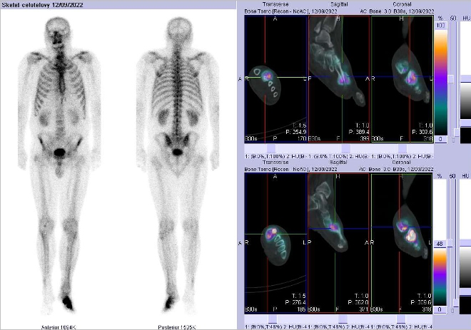 Obr..2: Celotlov scintigrafie a fze obraz SPECT a CT.  Zameno na loisko v lev noze. 