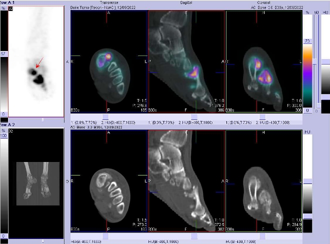 Obr.3: Fze obraz SPECT a CT.  Zameno na loisko v lev noze.