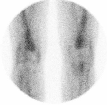 LeukoScan - scan po lb, projekce anterior