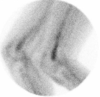 LeukoScan - scan po lb, laterln projekce