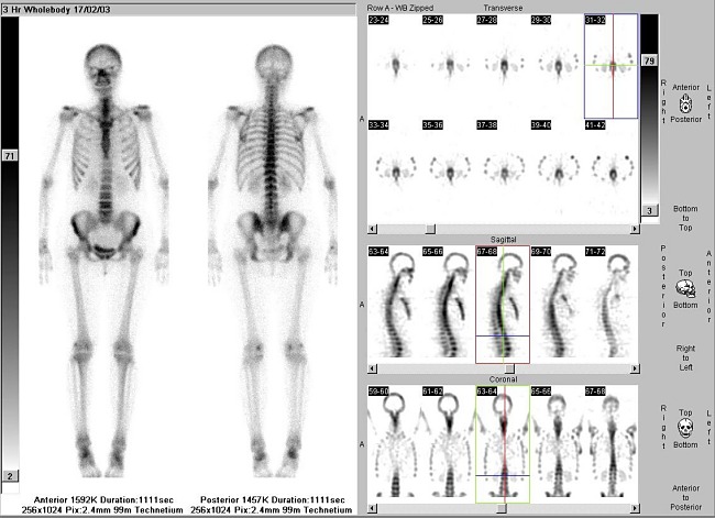 normln nlez na celotlov scintigrafii skeletu v pedn a zadn projekci (vlevo) a celotlovm SPECT vyeten
