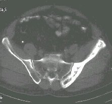 Obrázek č. 2.: CT břicha